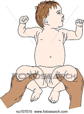 Nurse illiciting a positive Ortolani sign. Infant supine, knees to 90 degrees at the hips. With middle finger over greater trochanter of femur and thumb on internal side of thigh, hips are abducted with upward pressure. Resulting click is positive. View Large Illustration Stock Illustration - Nurse illiciting a positive Ortolani sign. Infant supine, knees to 90 degrees at the hips. With middle finger over greater trochanter of femur and thumb on internal side of thigh, hips are abducted with upward pressure. Resulting click is positive.. Fotosearch
