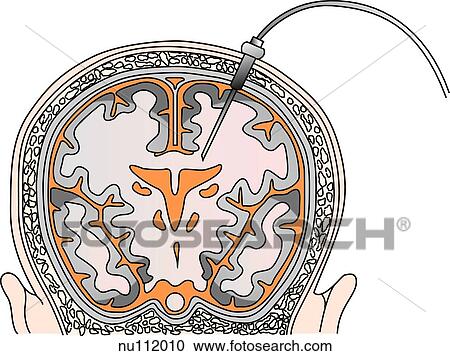 Clipart - Posterior view of head of infant, skull and brain are illustrated. A fiber-optic transducer-tipped catheter has been inserted through a subarachnoid bolt into the white matter of the brain.. Fotosearch