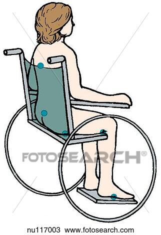 Posterolateral view of woman seated in wheel chair. View Large Illustration Drawing - Posterolateral view of woman seated in wheel chair.. Fotosearch