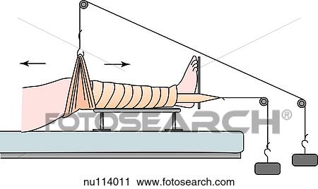 Clip Art - Principle of Russell traction. The bodyweight of the patient is the source of the counterweight for the leg and the traction is provided by weights. In addition, the leg is lIfted off the bed by a second set of weights.. Fotosearch