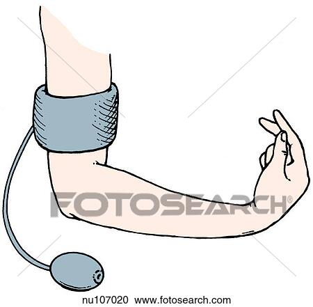 Right arm of patient showing positive Trousseau sign (carpopedal spasm) induced by occluding circulation in the arm with a blood pressure cuff. View Large Illustration Clipart - Right arm of patient showing positive Trousseau sign (carpopedal spasm) induced by occluding circulation in the arm with a blood pressure cuff.. Fotosearch