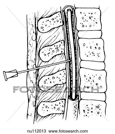 Sagittal section of lumbar area of spinal column showing pertinent anatomy. Needle inserted between vertebrae into cerebral spinal fluid (CSF). View Large Illustration Drawing - Sagittal section of lumbar area of spinal column showing pertinent anatomy. Needle inserted between vertebrae into cerebral spinal fluid (CSF).. Fotosearch