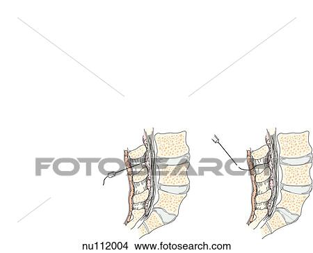 Sagittal section of lumbar area of spinal column showing pertinent anatomy. Left: needle inserted into epidural space between L3 and L4 vertebrae. Right: Needle is removed leaving catheter in place. View Large Illustration Stock Illustration - Sagittal section of lumbar area of spinal column showing pertinent anatomy. Left: needle inserted into epidural space between L3 and L4 vertebrae. Right: Needle is removed leaving catheter in place.. Fotosearch
