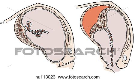 Drawing - Sagittal section of uterus. Left: placenta attached to uterine wall. Right: placenta separated from uterine wall.. Fotosearch
