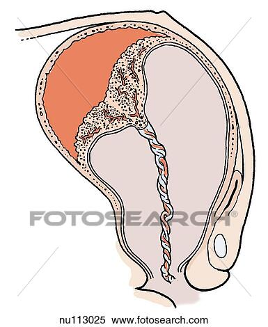 Sagittal section of uterus shortly after birth of baby, placenta has separated from uterine wall. View Large Illustration Stock Illustration - Sagittal section of uterus shortly after birth of baby, placenta has separated from uterine wall.. Fotosearch