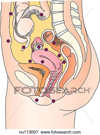 Sagittal view of female pelvic and abdominal regions showing common sites (dots) of endometriosus formation. View Large Illustration Stock Illustration - Sagittal view of female pelvic and abdominal regions showing common sites (dots) of endometriosus formation.. Fotosearch