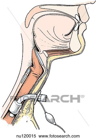 Sagittal view of the pharynx area showing a tracheostomy tube in place in the trachea. View Large Illustration Stock Illustration - Sagittal view of the pharynx area showing a tracheostomy tube in place in the trachea.. Fotosearch
