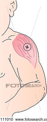 Shoulder and upper arm of child shown with deltoid muscle illustrated. Preferred site of injection is indicated by a + within a circle. View Large Illustration Clipart - Shoulder and upper arm of child shown with deltoid muscle illustrated. Preferred site of injection is indicated by a + within a circle.. Fotosearch