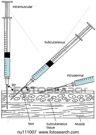 Simple drawing of cross section of skin with three needles administering injections at different angles. Intramuscular at 90 degrees (left), subcutaneous at 45 degrees (center), and intradermal at 15 degrees (right). View Large Illustration Stock Illustration - Simple drawing of cross section of skin with three needles administering injections at different angles. Intramuscular at 90 degrees (left), subcutaneous at 45 degrees (center), and intradermal at 15 degrees (right).. Fotosearch
