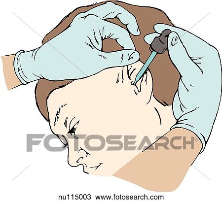 Technique of administrating eardrops in an adult by pulling the pinna of the ear up and back to straighten the ear canal. Drops are then placed on the side of the canal. View Large Illustration Drawing - Technique of administrating eardrops in an adult by pulling the pinna of the ear up and back to straighten the ear canal. Drops are then placed on the side of the canal.. Fotosearch