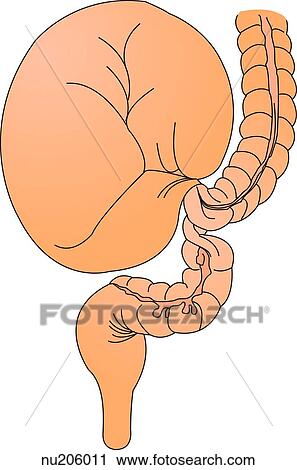 Clip Art - A loop of bowel twists causing the bowel lumen to become obstructed leading to the inability of stool to pass and compression of the blood supply to the looped bowel segment.. Fotosearch