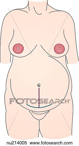 Anterior view of a pregnant woman with the two types of cesarian incisions, classic and transverse, indicated. View Large Illustration Stock Illustration - Anterior view of a pregnant woman with the two types of cesarian incisions, classic and transverse, indicated.. Fotosearch