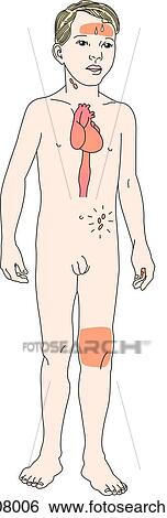Stock Illustration - Anterior view of boy with symptoms of Kawasaki disease illustrated: fever, conjunctivitis, strawberry tongue, swollen joints, abdominal pain, swollen glands, rash, vascular aneurysm and desquamation of palms.. Fotosearch