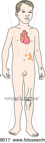 Anterior view of boy with symptoms of rheumatic fever illustrated: fever, carditis, erythema marginatum, subcutaneous nodules, chorea, C-reactive protein, polyarthritis and arthralgia. View Large Illustration Stock Illustration - Anterior view of boy with symptoms of rheumatic fever illustrated: fever, carditis, erythema marginatum, subcutaneous nodules, chorea, C-reactive protein, polyarthritis and arthralgia.. Fotosearch