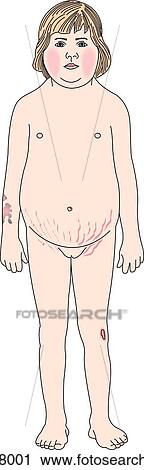 Anterior view of child with symptoms of Cushing's syndrome illustrated: hirsutism, red cheeks, moon face, ecchymoses, pendulous abdomen, abdominal striae, poor wound healing and thin arms and legs. View Large Illustration Clip Art - Anterior view of child with symptoms of Cushing's syndrome illustrated: hirsutism, red cheeks, moon face, ecchymoses, pendulous abdomen, abdominal striae, poor wound healing and thin arms and legs.. Fotosearch