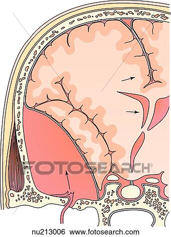Coronal section through the skull and brain reveals a epidural hematoma. The dark area in the lower left area is the hematoma. Note the broken blood vessel and the shift of midline structures. View Large Illustration Stock Illustration - Coronal section through the skull and brain reveals a epidural hematoma. The dark area in the lower left area is the hematoma. Note the broken blood vessel and the shift of midline structures.. Fotosearch