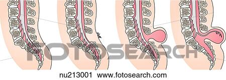 Clip Art - Four degrees of spinal cord anomalies. (left to right) Normal spinal cord, spina bifida occulta, meningocele, myelomeningocele.. Fotosearch