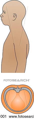 Illustration of chest contours of child. Top: lateral view of male child from waist up showing a barrel chest. Bottom: cross-section of barrel chest. View Large Illustration Clip Art - Illustration of chest contours of child. Top: lateral view of male child from waist up showing a barrel chest. Bottom: cross-section of barrel chest.. Fotosearch