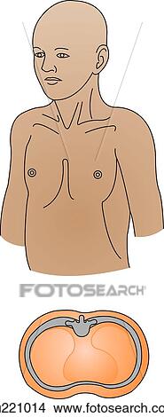 Illustration of chest contours of child. Top: anterior view of male child from waist up showing a funnel chest (pectus excavatum). Bottom: cross-section of funnel chest. View Large Illustration Stock Illustration - Illustration of chest contours of child. Top: anterior view of male child from waist up showing a funnel chest (pectus excavatum). Bottom: cross-section of funnel chest.. Fotosearch