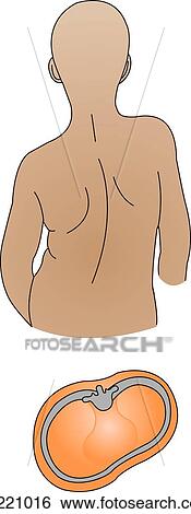 Illustration of chest contours of child. Top: posterior view of male child from waist up showing scoliosis. Bottom: cross-section of chest with kyphoscoliosis. View Large Illustration Stock Illustration - Illustration of chest contours of child. Top: posterior view of male child from waist up showing scoliosis. Bottom: cross-section of chest with kyphoscoliosis.. Fotosearch