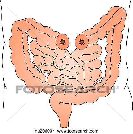 Illustration of intestinal tract of lower abdomen with a double-barrel colostomy created in the transverse portion of the colon. View Large Illustration Stock Illustration - Illustration of intestinal tract of lower abdomen with a double-barrel colostomy created in the transverse portion of the colon.. Fotosearch