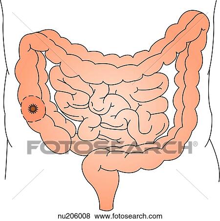 Illustration of intestinal tract of lower abdomen with a single-barrel colostomy created in the ascending portion of the colon. View Large Illustration Stock Illustration - Illustration of intestinal tract of lower abdomen with a single-barrel colostomy created in the ascending portion of the colon.. Fotosearch