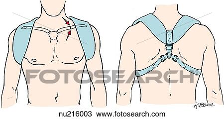 Drawing - Illustration showing method for immobilizing clavicular fracture with a clavicular strap.. Fotosearch