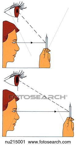 Illustration Showing Normal Pupil Constricting When Focusing On A Close Object And Dialating When Focusing On A Far Object Clip Art Nu Fotosearch