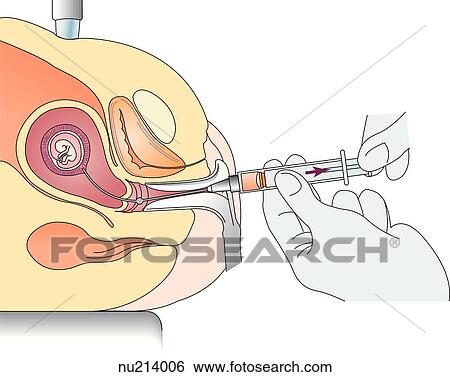 Stock Illustration - Illustration showing the technique for chorionic villi sampling. Soince the villi arise from trophoblast cells, their chromosome structure is the same as the fetus's.. Fotosearch