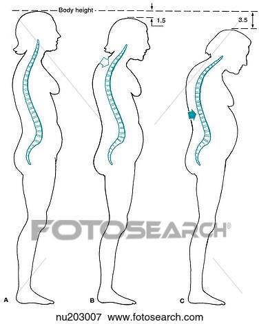 Image on left shows spinal column within outline of woman at 10 years postmenopause. Center shows changes (loss of height) at 15 years postmenopause. Image on right shows loss at 25 years postmenopause. View Large Illustration Stock Illustration - Image on left shows spinal column within outline of woman at 10 years postmenopause. Center shows changes (loss of height) at 15 years postmenopause. Image on right shows loss at 25 years postmenopause.. Fotosearch