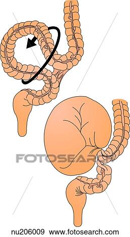 In the upper image the unattached loop of bowel twists causing the bowel lumen to become obstructed (bottom image) leading to the inability of stool to pass and compression of the blood supply to the looped bowel segment. View Large Illustration Stock Illustration - In the upper image the unattached loop of bowel twists causing the bowel lumen to become obstructed (bottom image) leading to the inability of stool to pass and compression of the blood supply to the looped bowel segment.. Fotosearch