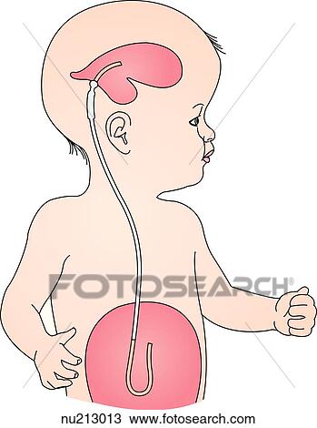 infant with a ventriculoperitoneal shunt in place. The shunt removes excess cerebrospinal fluid from the ventricles and shunts it to the peritoneum. A one-way valve is present inn the tubing behind the ear. View Large Illustration Drawing - infant with a ventriculoperitoneal shunt in place. The shunt removes excess cerebrospinal fluid from the ventricles and shunts it to the peritoneum. A one-way valve is present inn the tubing behind the ear.. Fotosearch