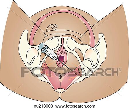 Stock Illustration - Inferior view of the female pelvic region showing location of injection for a pudendal nerve block.. Fotosearch