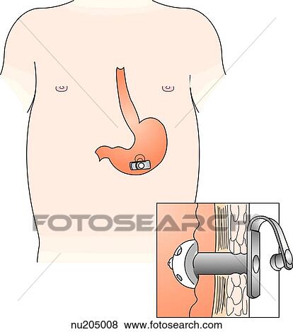 Stock Illustration - Internal placement of gastrostomy button in a child. Insert shows how button is placed at internal wall of stomach.. Fotosearch