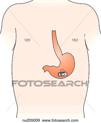 Stock Illustration - Internal placement of gastrostomy button in a child. . Fotosearch