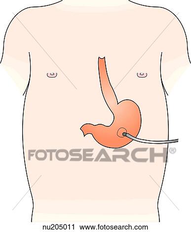 Internal placement of gastrostomy tube in a child. View Large Illustration Clip Art - Internal placement of gastrostomy tube in a child. . Fotosearch