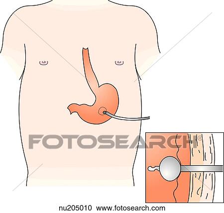 Internal placement of gastrostomy tube in a child. Insert shows how catheter is placed with inflated baloon up and internal wall of stomach. View Large Illustration Clipart - Internal placement of gastrostomy tube in a child. Insert shows how catheter is placed with inflated baloon up and internal wall of stomach.. Fotosearch
