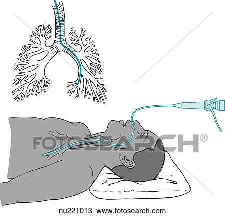 Drawing - Lateral view of a male patient on his back with a fiberoptic bronchoscope inserted nasally to the smaller bronchus. Image at top shows location of tip of bronchoscope.. Fotosearch