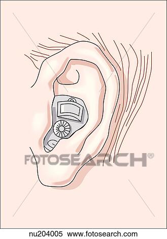 Lateral view of left ear with hearing aid located in the concha of ear. View Large Illustration Stock Illustration - Lateral view of left ear with hearing aid located in the concha of ear.. Fotosearch