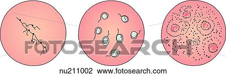 Microscopic view of three common vulvovaginitis ifections; candida (left); herpesvirus type II (middle); gardnerella (right). View Large Illustration Drawing - Microscopic view of three common vulvovaginitis ifections; candida (left); herpesvirus type II (middle); gardnerella (right).. Fotosearch
