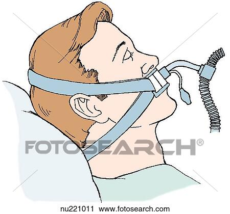 Patient being administered oxygen via endotracheal tube with a T-piece adapter. A T-piece adapter is attached to the endotrachueal tube and large-bore tubing, which serves as a source of oxygen and humidity. View Large Illustration Clip Art - Patient being administered oxygen via endotracheal tube with a T-piece adapter. A T-piece adapter is attached to the endotrachueal tube and large-bore tubing, which serves as a source of oxygen and humidity.. Fotosearch