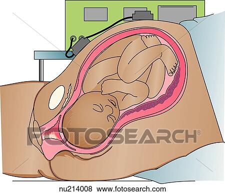 Stock Illustration - Placement of electronic monitoring leads. External leads to monitor for FHR and uterine contractions.. Fotosearch