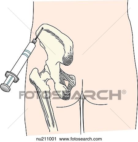 Posterior view of the pelvic region illustrating a common site used for bone marrow aspiration, especially in children, the iliac crest. The anterior tibia can also be used. View Large Illustration Clip Art - Posterior view of the pelvic region illustrating a common site used for bone marrow aspiration, especially in children, the iliac crest. The anterior tibia can also be used.. Fotosearch