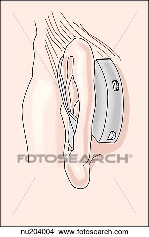 Posterolateral view of left ear with hearing aid located behind the auricle of the ear. View Large Illustration Stock Illustration - Posterolateral view of left ear with hearing aid located behind the auricle of the ear.. Fotosearch