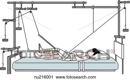 Principle of balanced suspension traction. The counterweight and traction is provided by weights which pulled in different directions as seen in this illustration. View Large Illustration Clip Art - Principle of balanced suspension traction. The counterweight and traction is provided by weights which pulled in different directions as seen in this illustration. . Fotosearch