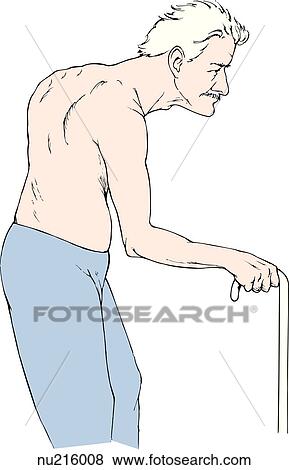 Stock Illustration - Profile of elderly man exhibiting the musculoskeletal defect of kyphosis.. Fotosearch