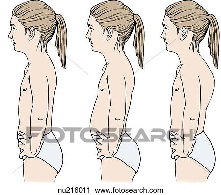 Profile of female child exhibiting musculoskeletal problems. Left: child with normal spine. Middle: child with lordosis. Right: child with kyphosis. View Large Illustration Clip Art - Profile of female child exhibiting musculoskeletal problems. Left: child with normal spine. Middle: child with lordosis. Right: child with kyphosis.. Fotosearch