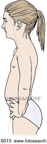 Profile of female child exhibiting the musculoskeletal defect of lordosis. View Large Illustration Drawing - Profile of female child exhibiting the musculoskeletal defect of lordosis.. Fotosearch