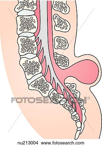 Sagittal 光景 の 背骨の コラム そして 脊髄 で A Meningocele イラスト Nu Fotosearch
