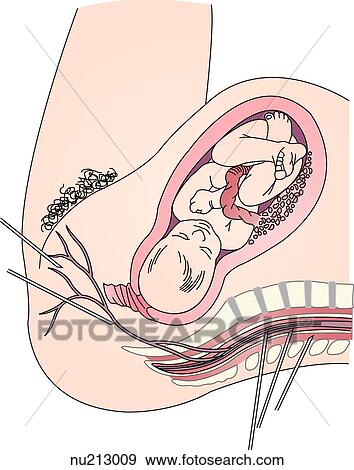 Sagittal anatomy of the spinal canal and sites of injection for regional anethesia. View Large Illustration Stock Illustration - Sagittal anatomy of the spinal canal and sites of injection for regional anethesia.. Fotosearch